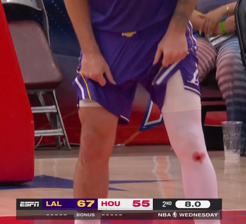 东契奇库里膝上血迹真相 反复地板擦伤致疤痕撕裂渗血